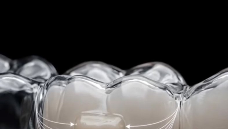 Alinhador transparente sobre os dentes